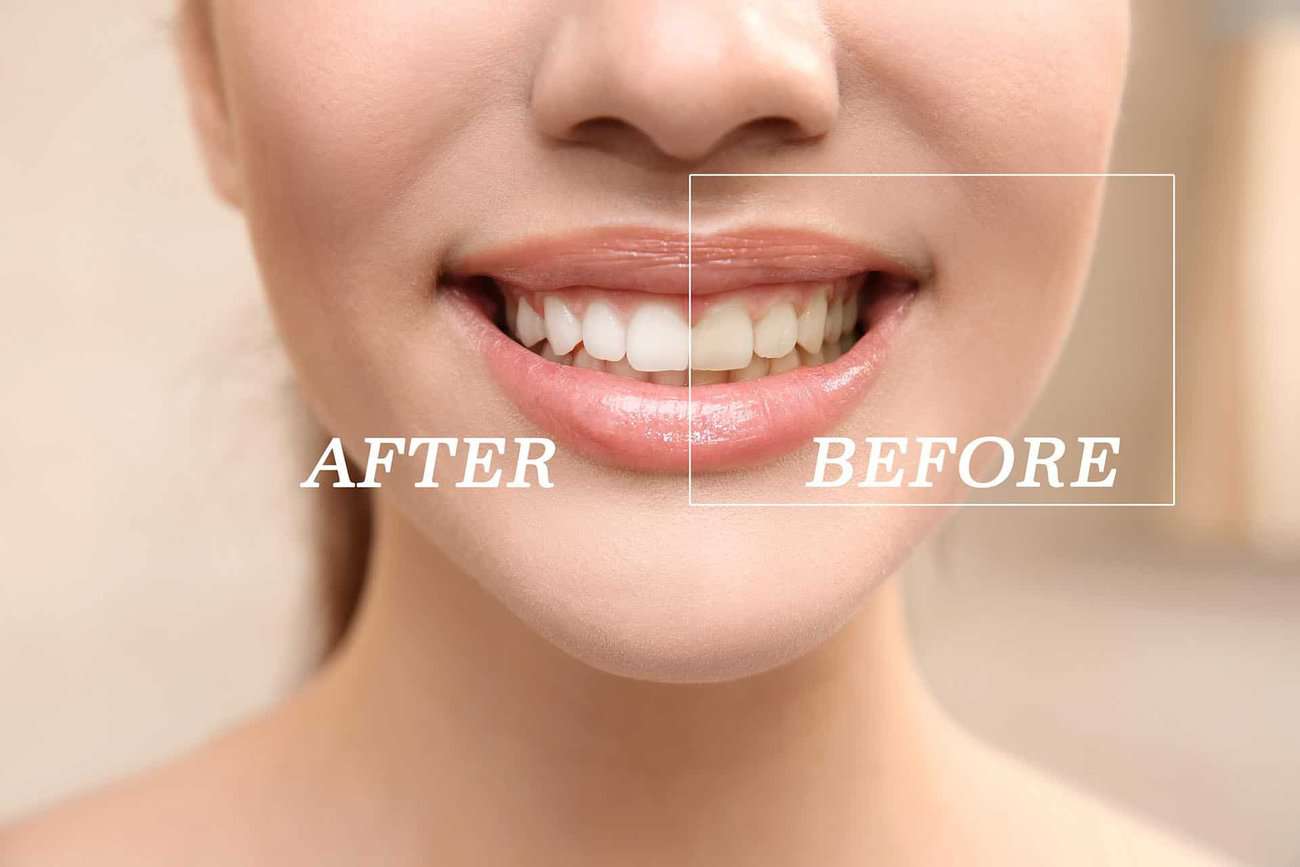 What Are the Most Effective Natural Teeth Whitening Methods You Can Try Bath?