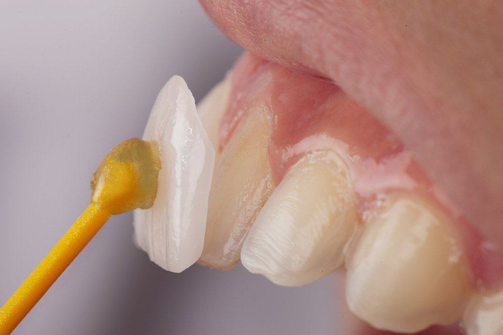 How Do Dental Crowns Improve Your Oral Health?
