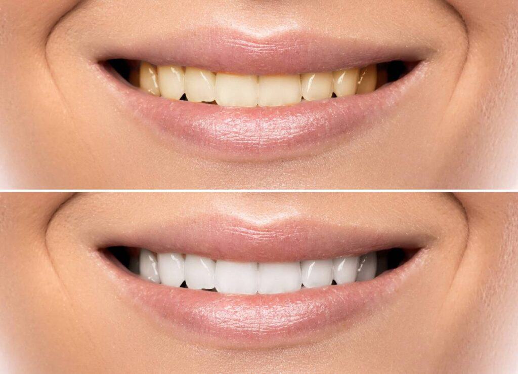 How Does Gum Disease Progress if Left Untreated Bath?