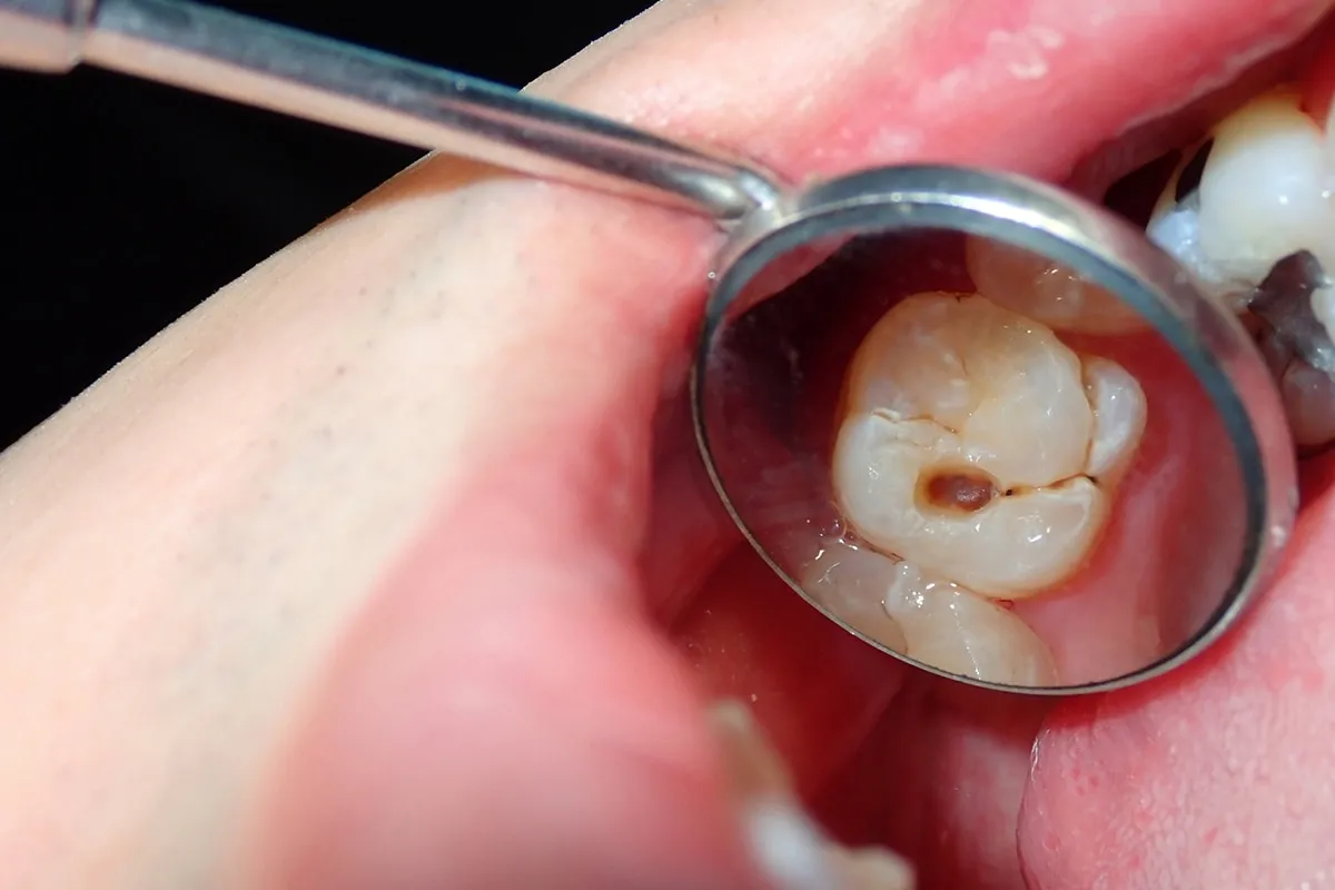 Why Do Teeth Crack? Common Causes to Know Bath