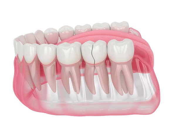 How Can You Manage Pain and Discomfort After a Root Canal Bath?
