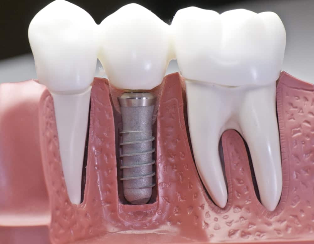 Who Is a Good Candidate for Dental Implants Bath?