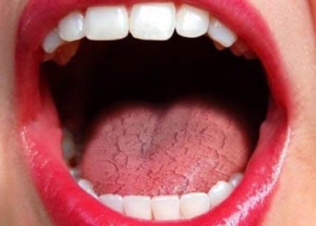 Common Causes of Dry Mouth (Xerostomia) Bath