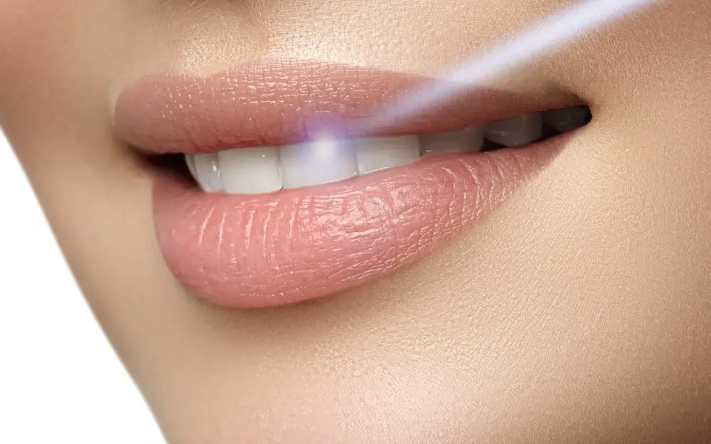 How Quickly Will You See Results After Laser Teeth Whitening Bath?
