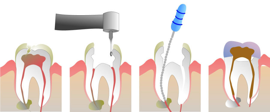 How Do You Properly Care for Your Teeth After a Root Canal Bath
