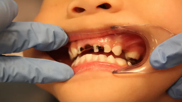Which Foods and Drinks Cause the Most Damage to Young Smiles Bath?