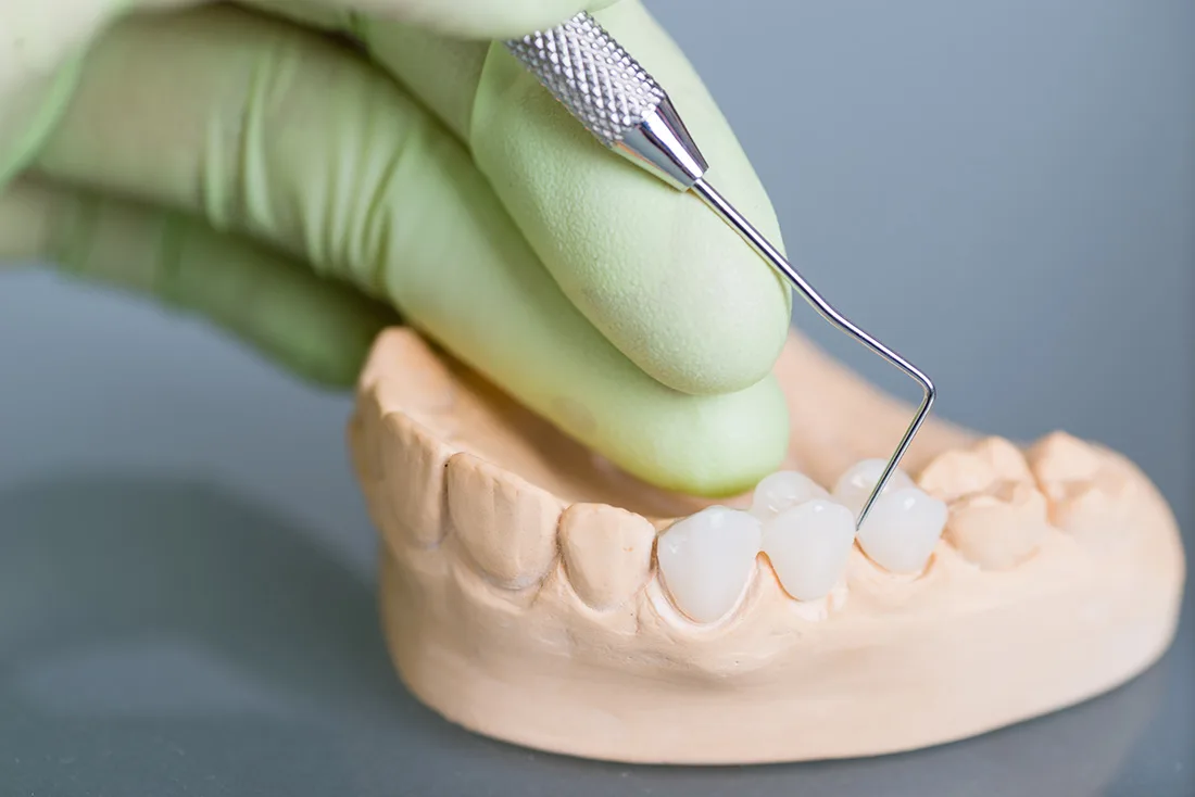 What Are the Different Types of Dental Crowns Available Bath?