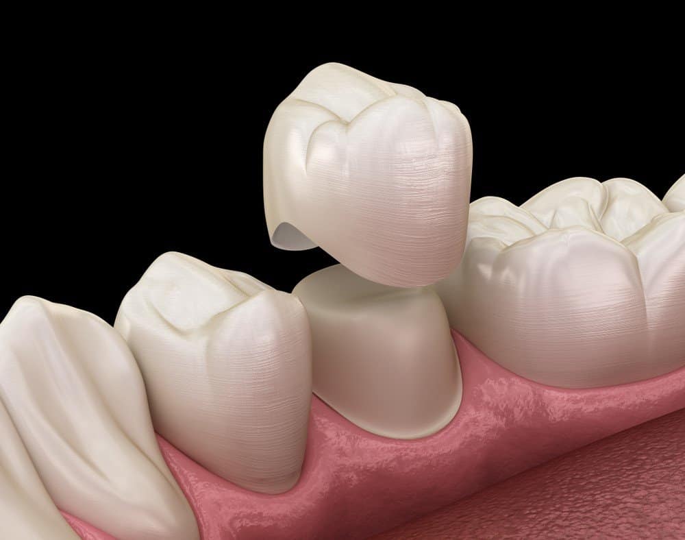 What is the Procedure for Getting Dental Implants Bath?