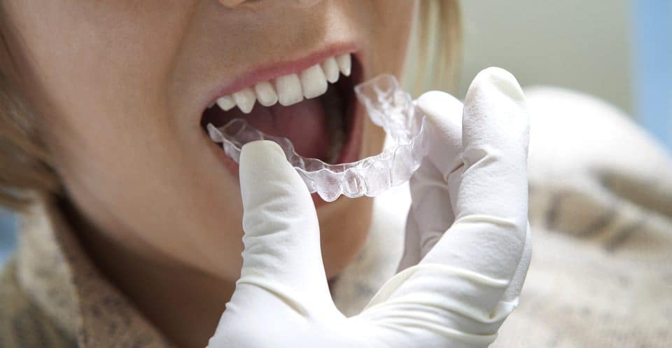 Why Bleaching Trays Require More Time Bath