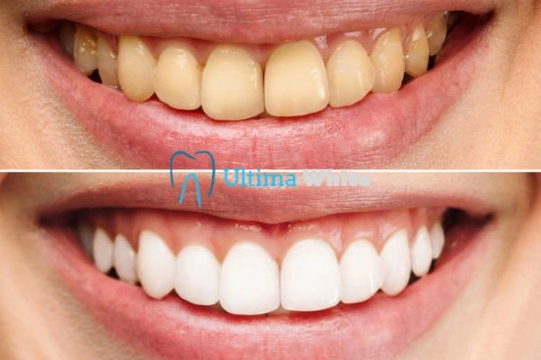 Oral Care Tips for Current and Former Smokers Bath