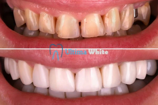 What Makes Instant Teeth Whitening Treatments So Popular Bath?