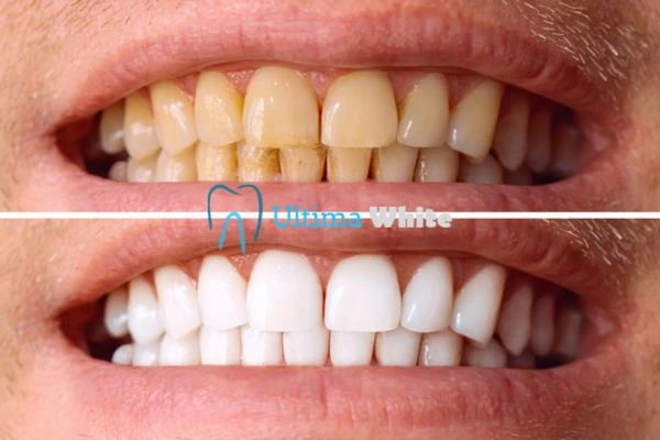 Stained Teeth and Persistent Bad Breath Bath
