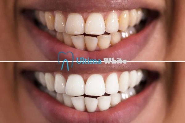 Aftercare Tips to Maintain Your New Smile Bath